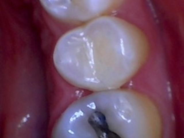 Smile gallery dentist image of dental patient Composite Restoration Posterior post service