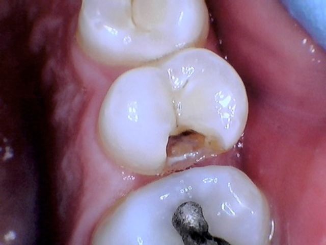 Smile gallery dentist image of dental patient Composite Restoration Posterior pre service