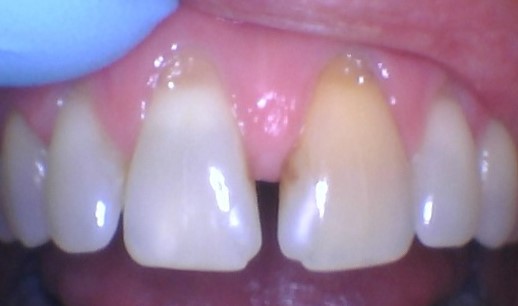 Smile gallery dentist image of dental patient Diastema Closure pre service