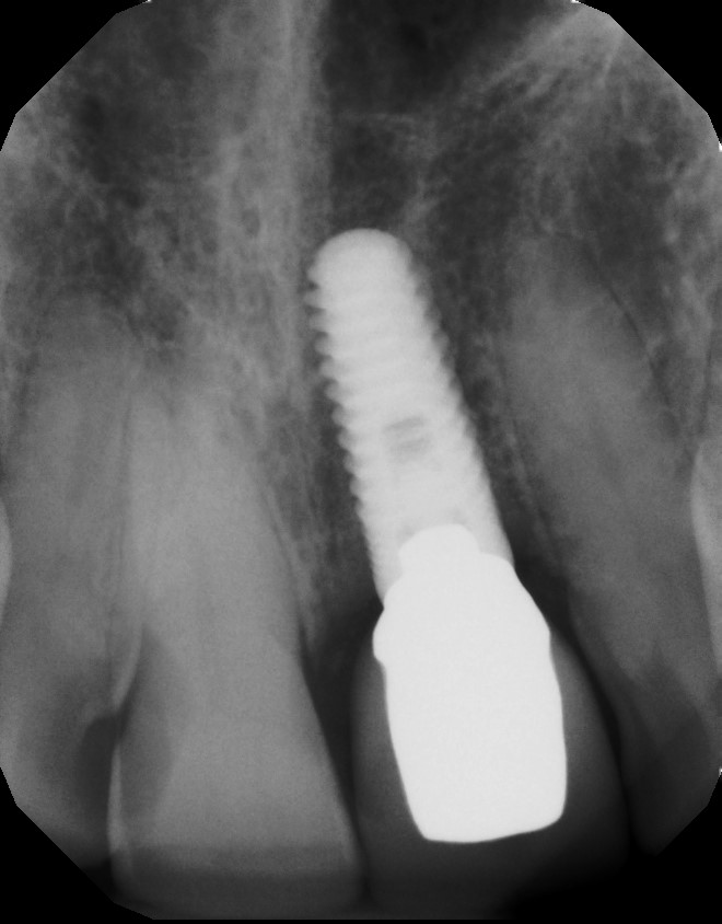 Smile gallery dentist image of dental patient Implant Zimmer Resorption 9 post service