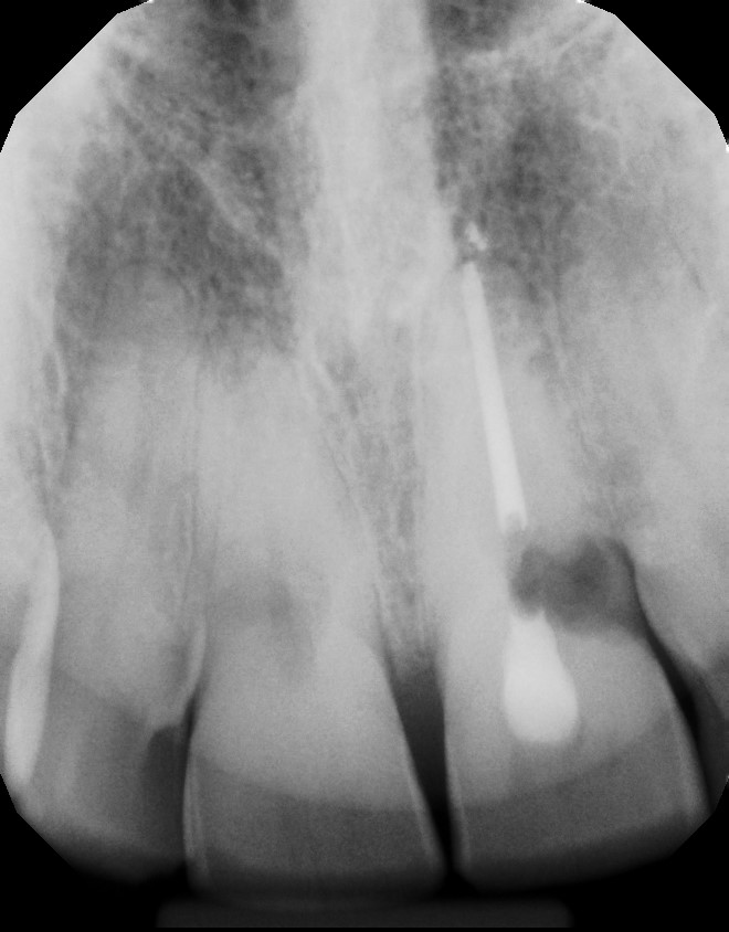 Smile gallery dentist image of dental patient Implant Zimmer Resorption 9 pre service