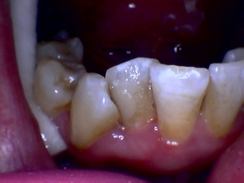 Smile gallery dentist image of dental patient Prophy 23-26 post service