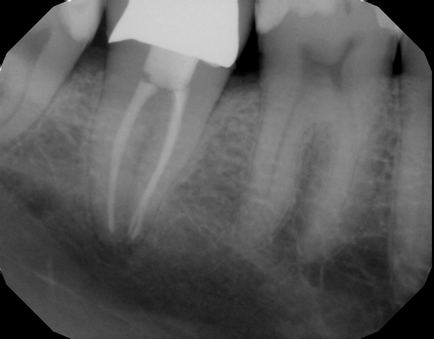 Smile gallery dentist image of dental patient Root Canal Posterior post service