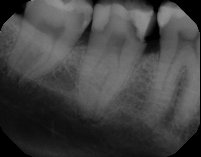 Smile gallery dentist image of dental patient Root Canal Posterior pre service