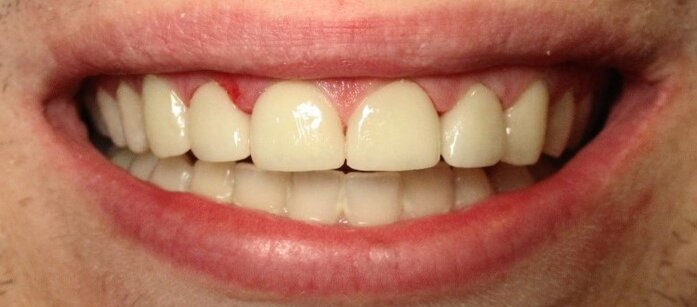 Smile gallery dentist image of dental patient veneers post service