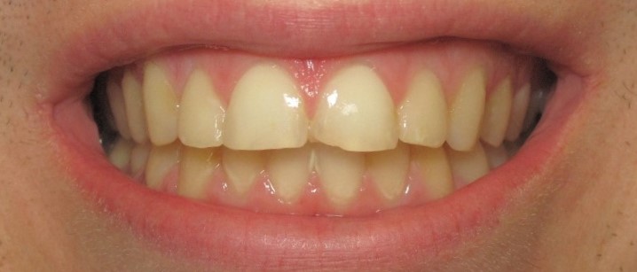 Smile gallery dentist image of dental patient veneers pre service