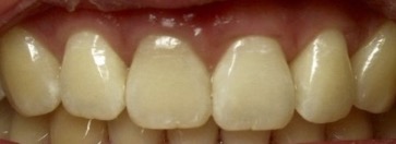 Smile gallery dentist image of dental patient whitening post service