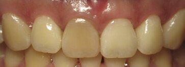 Smile gallery dentist image of dental patient whitening pre service