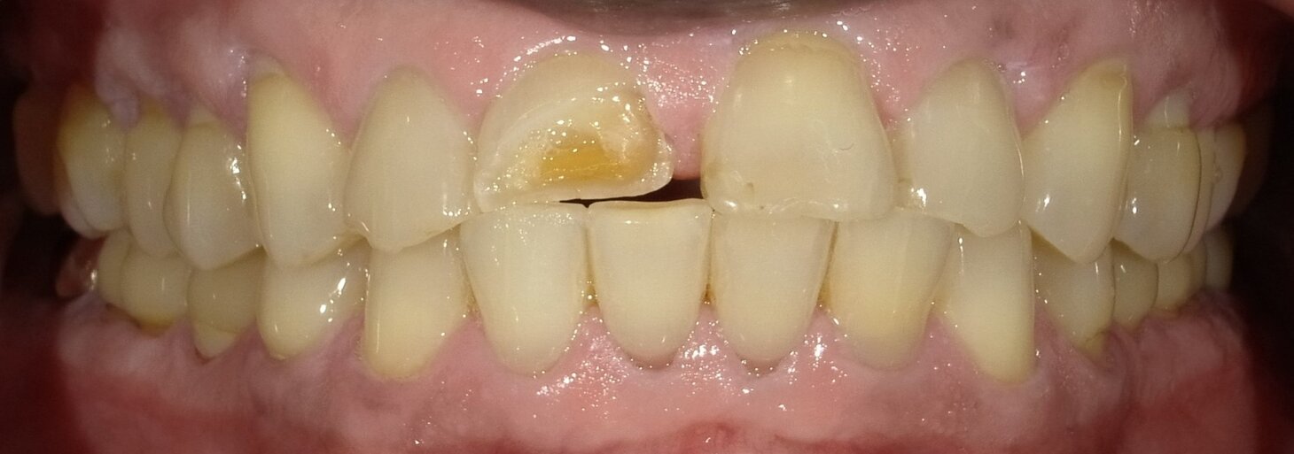 Smile gallery dentist image of crowns 7-10 eo pre service