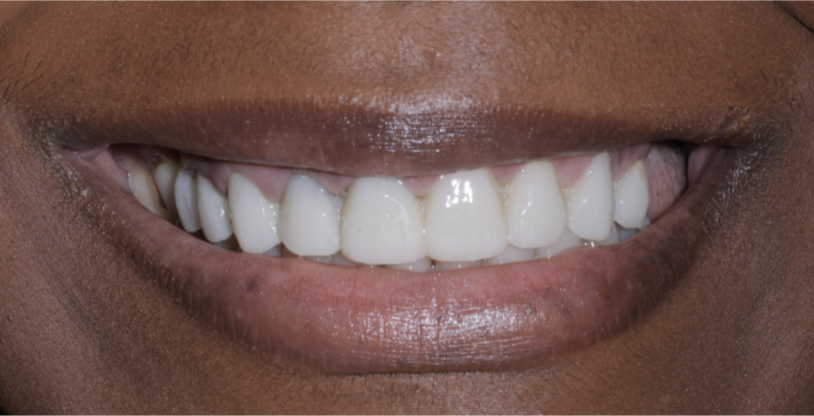 Smile gallery dentist image of dental patient upper crown post service