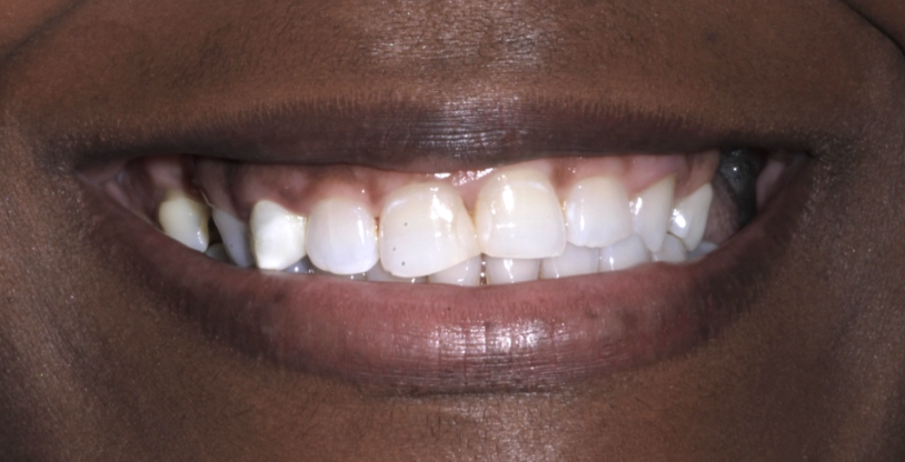 Smile gallery dentist image of dental patient upper crown pre service